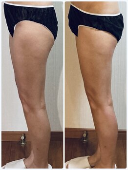 ブルームオーラ 月(BLOOM AURA)/下半身痩せ・まずはリンパから