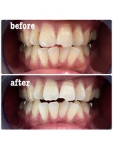 ルフレ(Reflet)/1回目でここまで変わりました♪