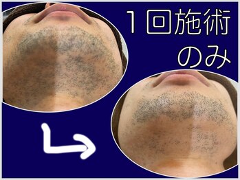 ファシネイト 新宿本店(Fascinate)/ヒゲ脱毛１回施術のみの経過です
