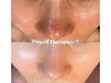 ルイース(LOUISE.)/プロセルセラピーズ肌質改善