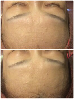 プロぺ鍼灸整骨院/シワ・老化肌改善！