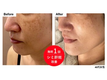 ボニータアンジュ 恵比寿(Bonita Ange)/シミケア◆エクソ×幹細胞導入