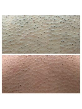 アンジェリーナ/30代/ヒゲ脱毛/6回