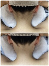 ルルトウキョウ 池袋店(LULU.tokyo)/うなじ脱毛