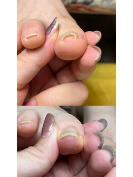 巻き爪ケア
