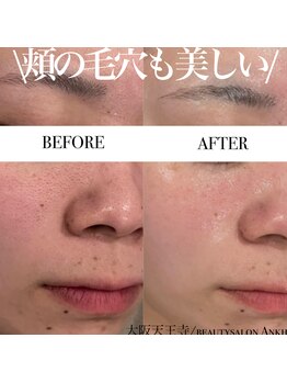 アンク(Ankh)/頬の毛穴も美しい