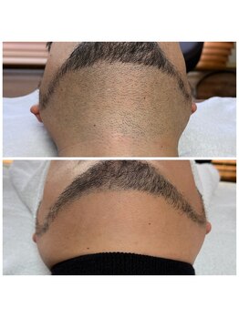 フェリス(FELIZ)/メンズ脱毛人気No.1