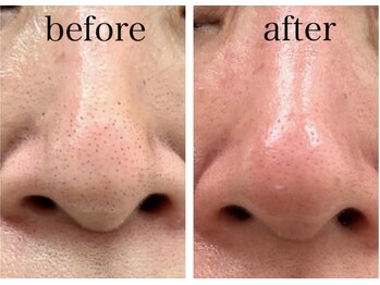 ネイルサロン きらら 平塚店/韓国式３D毛穴洗浄