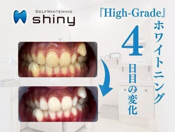 ホワイトニングサロン シャイニー 浜松細島店(shiny)/【超絶・美・白】ホワイトニング