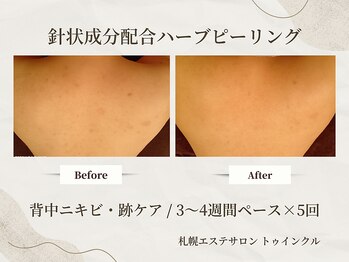 プライベートエステサロン トゥインクル/【背中ニキビ・跡】上部集中ケア