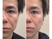 アース 佐賀鳥栖店(HAIR&MAKE EARTH)の雰囲気（コラーゲン糸と光フェイシャルや高周波でハリツヤ引き締めケア）