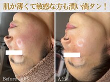 ぷるる 練馬 江古田/40代　ララピール＋ゲルマスク