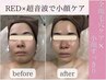 【顔全体の毛穴大掃除】トルネード洗浄×超音波！小顔印象＆ツルピカ肌