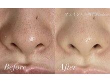 シェーン(Schon)/ブラックピーリング