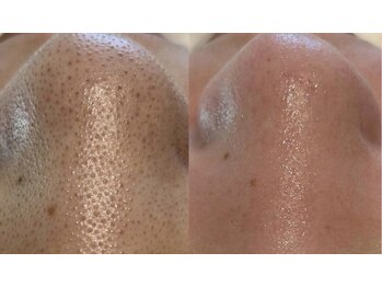 毛穴専科の写真/＼ハイドラ毛穴洗浄￥3,980／リピート率89％！効果保証・全額返金保証◎毛穴黒ずみやニキビを徹底改善◎