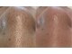 毛穴専科の写真/＼ハイドラ毛穴洗浄￥3,980／リピート率89％！効果保証・全額返金保証◎毛穴黒ずみやニキビを徹底改善◎