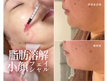 ハーボプラス(THE HEARBO plus)の雰囲気（「なんだか顔が大きく見える」を解消♪二重あご・輪郭をすっきり）