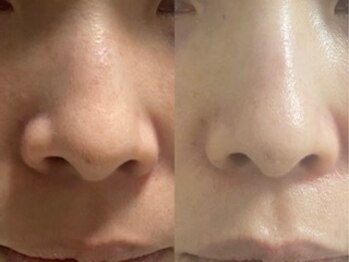 サクラ(SAKURA)/こんなに美白◎毛穴・乾燥・キメ