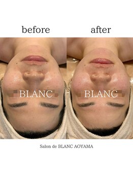サロン ド ブラン アオヤマ(Salon de BLANC AOYAMA)/リフトアップで輪郭も整える
