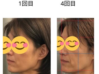 ベル/50代の方の小顔Before After