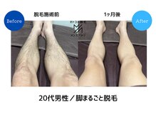 メンズアメリ/高知/メンズ脱毛/ヒゲ/全身/VIO