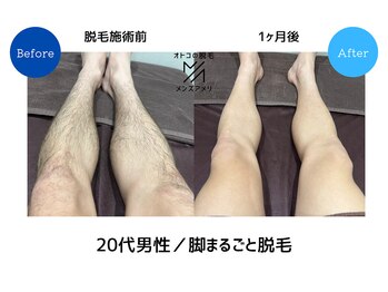 メンズアメリ/高知/メンズ脱毛/ヒゲ/全身/VIO