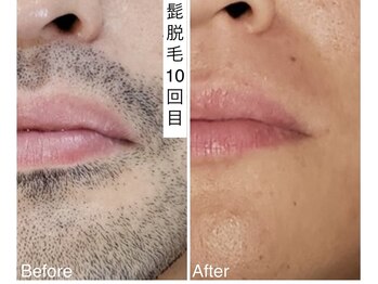 CDF 赤坂/メンズヒゲ脱毛２回目初回￥2000