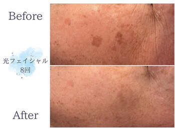 ディアスマイル(Dear.smile)/光フェイシャル8回