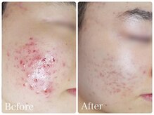 ロイヤル(ROYAL)/ニキビ改善症例