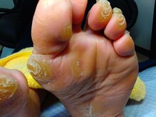 ドクターネイル爪革命 秋津店/固く蓄積したタコ