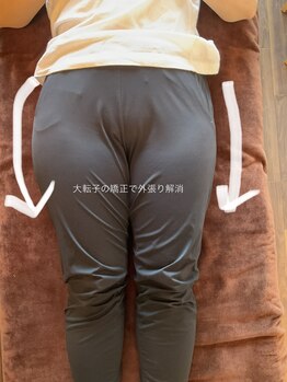 カオン(Kaon)/大転子矯正で横張り解消