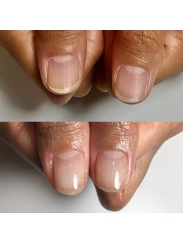 セラキュアネイル(Theracure nail)/美爪育成で美しい爪に整える