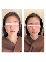 アクア エステティコ 亀有(ACQUA estetico)/小顔リフトUP エイジングケア