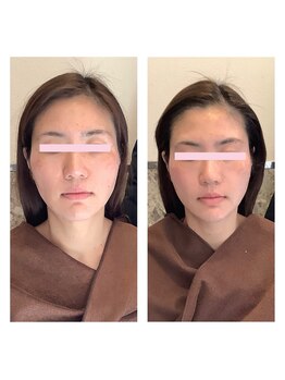 アクア エステティコ 亀有(ACQUA estetico)/小顔リフトUP エイジングケア