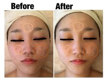 エステティックサロン アンジュ(Angu)の雰囲気(20代のお客様!2週おきの施術を受けた2年後!)