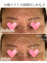 ココロ(COCORO)/おでこのシワも！施術１回で