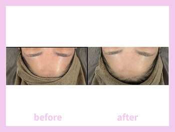 キワミビューティ(KIWAMI BEAUTY)/塗る金の糸/ビフォーアフター