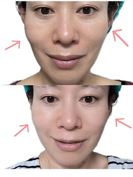 そら/小顔、リフトアップ　神経整体