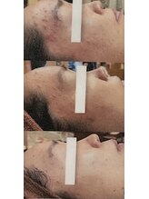 プレジール(PLAISIR)/炭酸パック　Before・After