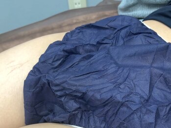 あおのアルパカ/脱毛