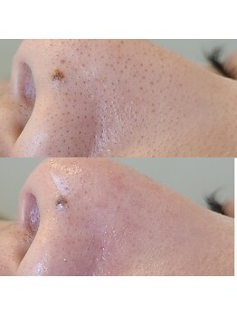 リンド(Lindo)/ハイドロスプラッシュ毛穴洗浄