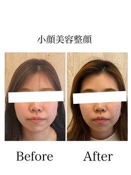 サロンベイビー 西宮本店(Salon Baby)/【BeforeAfter】小顔美容整顔