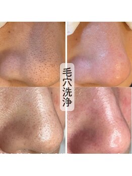 ココロ(COCORO)/毛穴洗浄