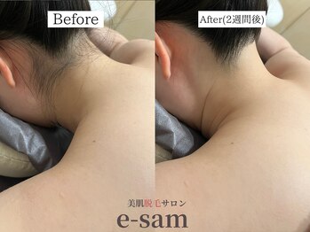 イーサム 高槻摂津富田店(e-sam)/丸ごと全身脱毛