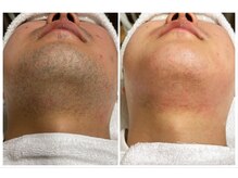 ヴァイオス 新宿店(VIOS)/◆ヒゲ脱毛【東京都最安値級！】