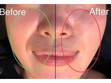 ザ コンディショニングルーム コガオスタジオ 自由が丘店(KOGAOSTUDIO)/ビフォーアフター　ほうれい線