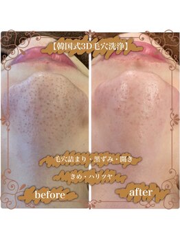 プレシャス(Precious)/【韓国式3D毛穴洗浄】