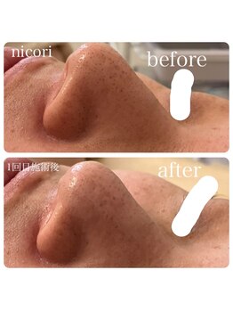 ニコリ(nicori)/【毛穴ケア】beforeとafter