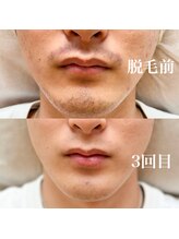 オルテンシア(Hortensia)/顔脱毛/ヒゲ脱毛