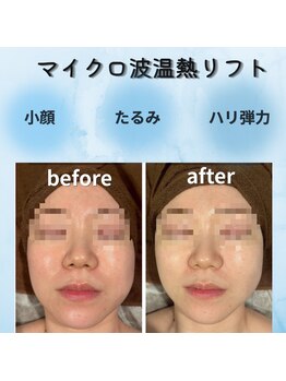 インナーグロウ 中目黒(INNER GLOW)の写真/30代からの「落ちてきた？」を速攻ケア！最新鋭のマイクロ波×レッドショットで、自分史上最高の小顔へ♪